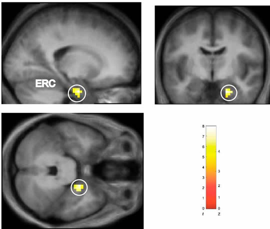 tre tac del cervello che evidenziano in giallo l'attivazione ippocampo con barra di misurazione in fondo a destra